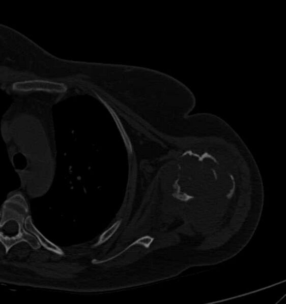 File:Clear cell chondrosarcoma - humerus (Radiopaedia 63104-71612 Axial bone window 56).jpg