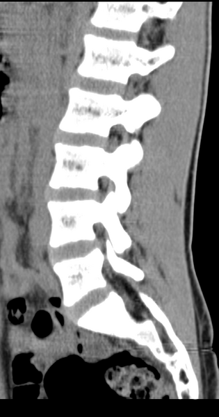 File:Clear cell meningoma - lumbar spine (Radiopaedia 60116-67691 A 27).png