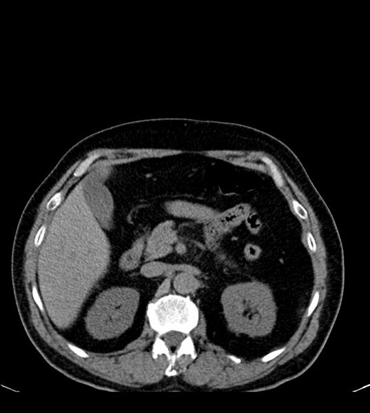 File:Clear cell renal cell carcinoma (Radiopaedia 85006-100539 Axial non-contrast 31).jpg