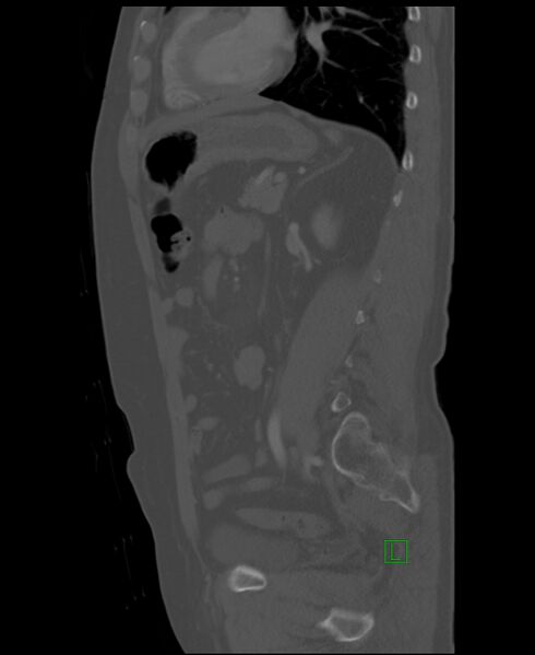 File:Clear cell renal cell carcinoma (Radiopaedia 85006-100539 Sagittal bone window 22).jpg
