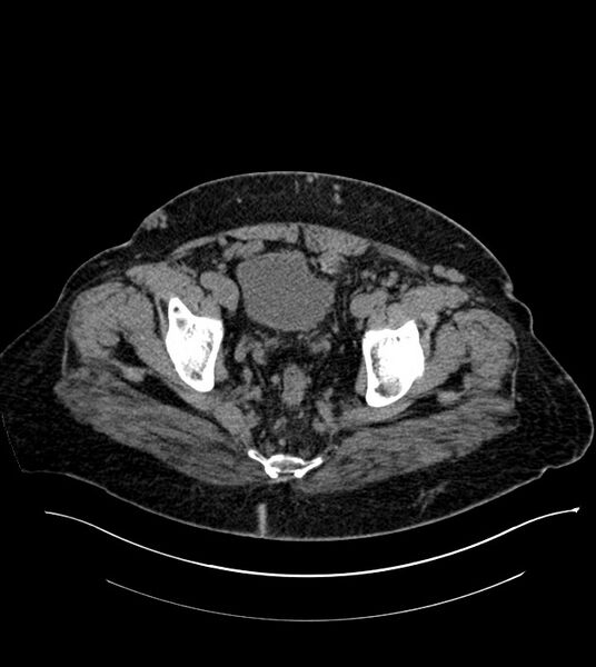 File:Closed-loop small bowel obstruction-internal hernia (Radiopaedia 78439-91096 Axial non-contrast 139).jpg