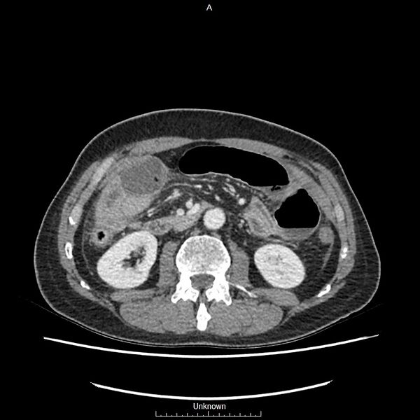 File:Closed loop bowel obstruction and ischemia (Radiopaedia 86959-103180 A 35).jpg