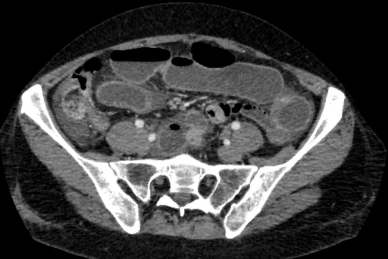 File:Closed loop small bowel obstruction (Radiopaedia 71211-81508 A 106).jpg