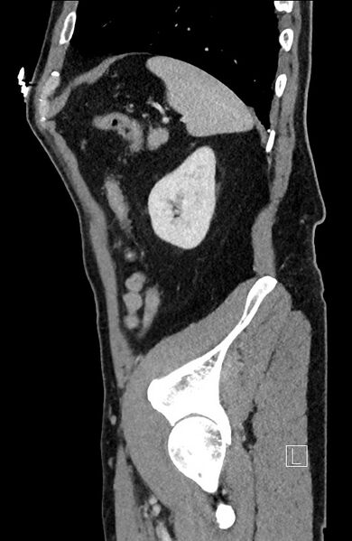 File:Closed loop small bowel obstruction - internal hernia (Radiopaedia 57806-64778 C 26).jpg