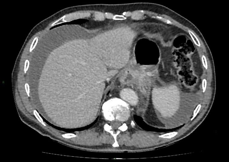 File:Closed loop small bowel obstruction with ischemia (Radiopaedia 84180-99456 A 18).jpg