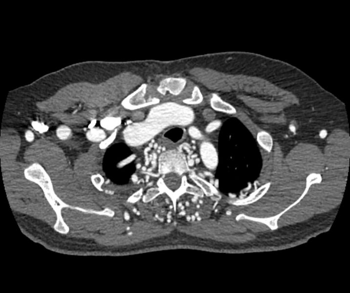 File:Coarctation of the aorta (Radiopaedia 53752-59822 A 24).jpg