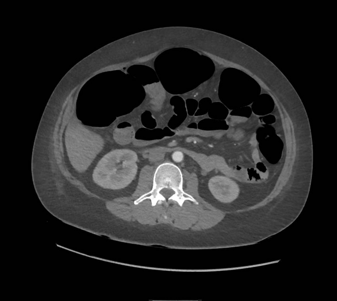File:Colonic pseudo-obstruction (Radiopaedia 79752-92980 A 89).png