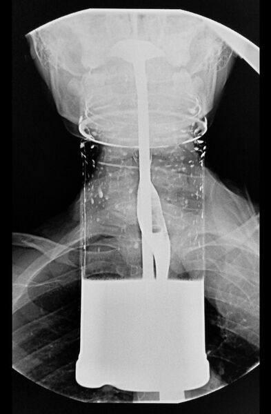 File:Esophagram - with glass and straw (Radiopaedia 64020).jpg