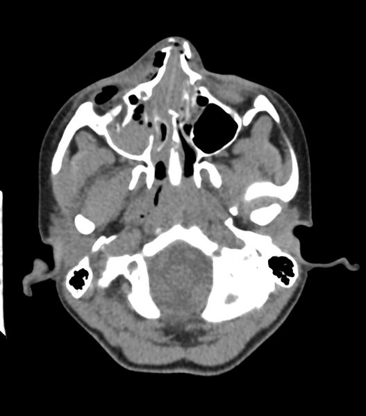 File:Nasoorbitoethmoid fracture (Radiopaedia 90044-107205 Axial non-contrast 136).jpg