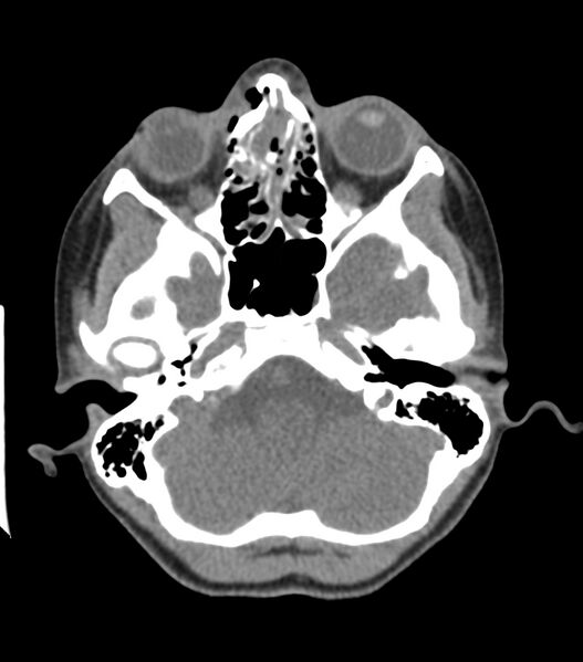File:Nasoorbitoethmoid fracture (Radiopaedia 90044-107205 Axial non-contrast 150).jpg