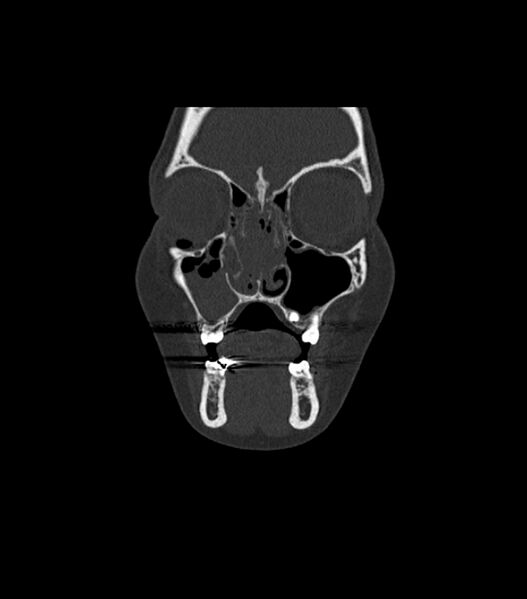 File:Nasoorbitoethmoid fracture (Radiopaedia 90044-107205 Coronal bone window 39).jpg