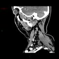 Nasopharyngeal lymphoma (Radiopaedia 54235-60432 B 31).jpg