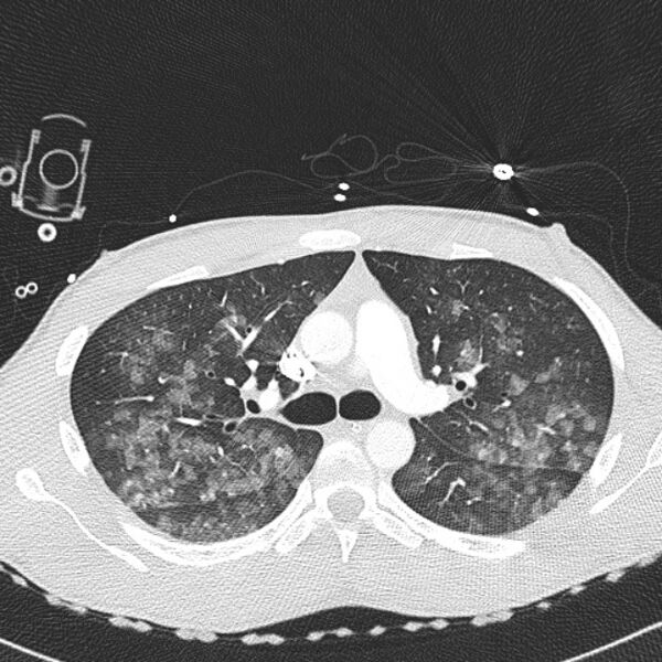 File:Near drowning (pulmonary edema) (Radiopaedia 24685-24958 lung window 12).jpg