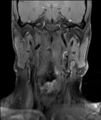 Neurofibromatosis type 1 (Radiopaedia 80355-93740 Coronal T1 1).jpg