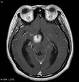 Neurofibromatosis type 2 - cranial and spinal involvement (Radiopaedia 5351-7111 Axial T1 C+ 10).jpg