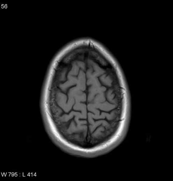 File:Neurosarcoidosis (Radiopaedia 10930-11351 Axial T1 18).jpg
