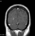 Neurosarcoidosis (Radiopaedia 10930-17204 Coronal T1 C+ 18).jpg