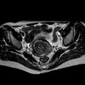 Non-puerperal uterine inversion (Radiopaedia 78343-90983 Axial T2 22).jpg