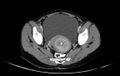 Non-puerperal uterine inversion (Radiopaedia 78343-91094 A 32).jpg