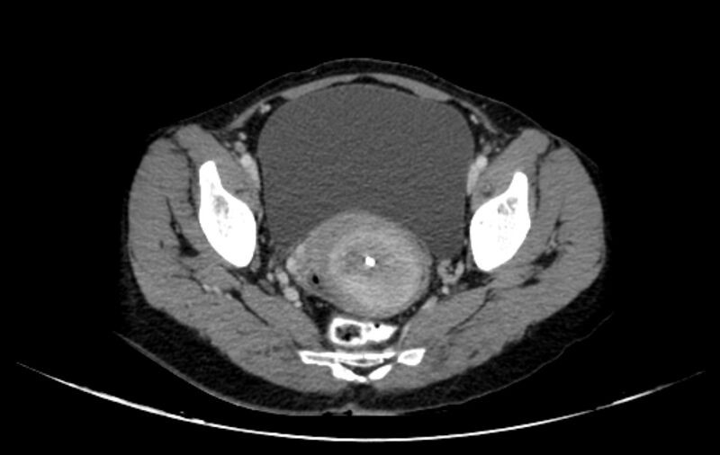 File:Non-puerperal uterine inversion (Radiopaedia 78343-91094 A 32).jpg