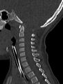 Normal CT cervical spine - pediatric (Radiopaedia 52549-58462 Sagittal bone window 108).jpg