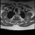 Normal cervical and thoracic spine MRI (Radiopaedia 35630-37156 Axial T1 4).png