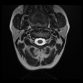 Normal cervical and thoracic spine MRI (Radiopaedia 35630-37156 Axial T2 29).png