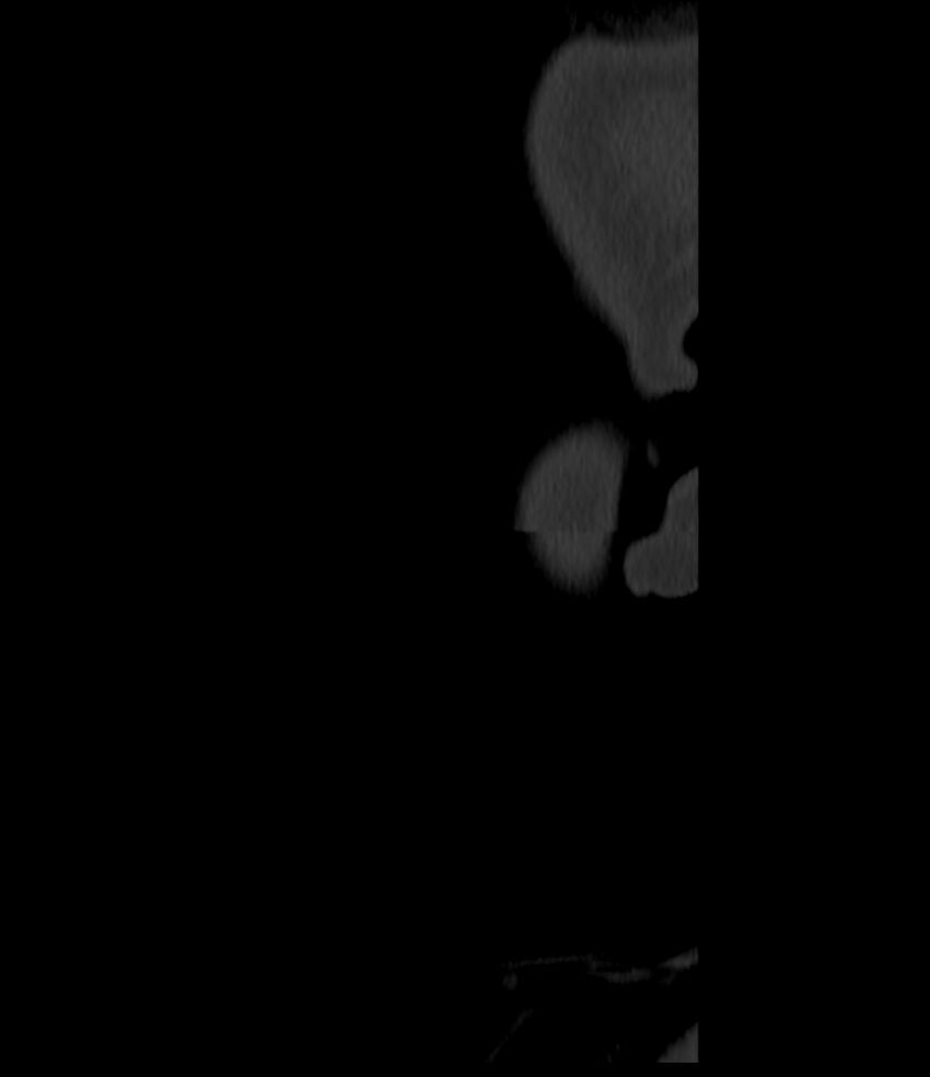 Normal facial bone CT (Radiopaedia 88742-105476 Sagittal bone window 166).jpg