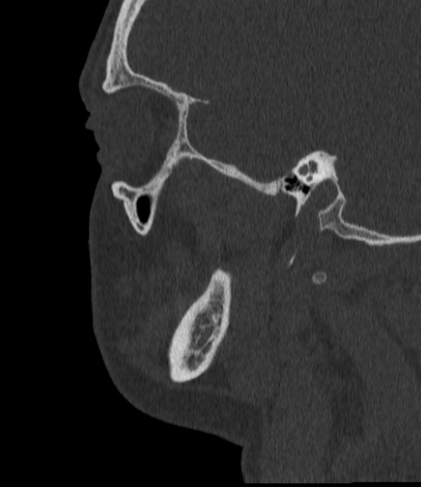 Normal facial bone CT (Radiopaedia 88742-105476 Sagittal bone window 49).jpg