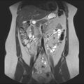 Normal liver MRI with Gadolinium (Radiopaedia 58913-66163 Coronal T2 18).jpg