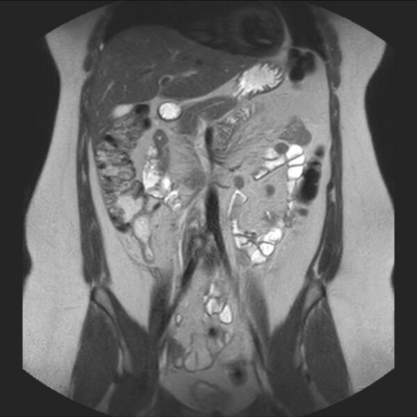 File:Normal liver MRI with Gadolinium (Radiopaedia 58913-66163 Coronal T2 18).jpg