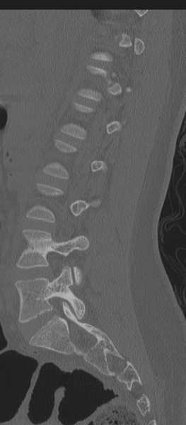 File:Normal lumbosacral CT (Radiopaedia 37923-39867 Sagittal bone window 62).png