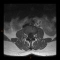 Normal spine MRI (Radiopaedia 77323-89408 Axial T1 6).jpg