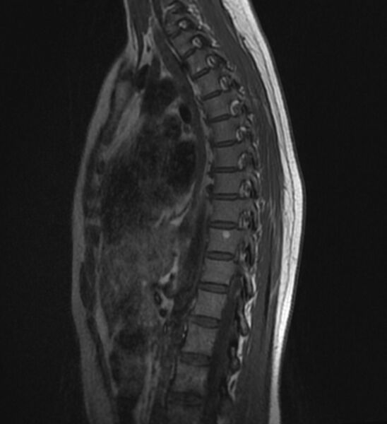 File:Normal thoracic spine MRI (Radiopaedia 41033-43781 Sagittal T1 9).jpg