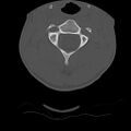 Normal trauma spine imaging (age 16) (Radiopaedia 45335-49358 Axial bone window 21).jpg