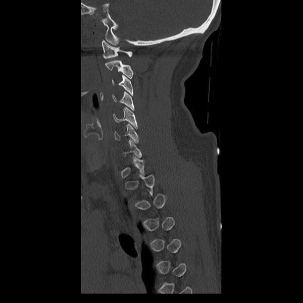 File:Occipital condyle fracture (Radiopaedia 31755-32691 Sagittal bone window 10).jpg