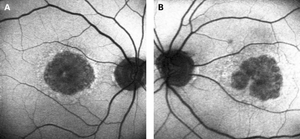 Images of geographic atrophy in age-related macular degeneration.