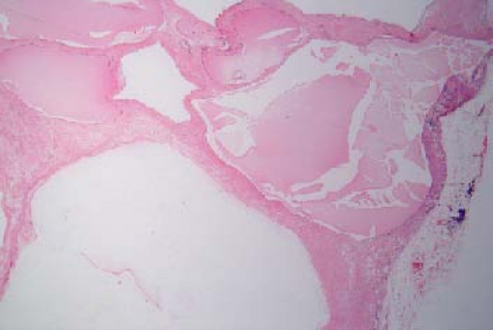 Cystic nephroma: Microscopic appearance.