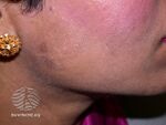 Postinflammatory pigmentation (DermNet NZ colour-hyperpig2).jpg