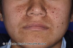 Multiple fibrous papules of the face