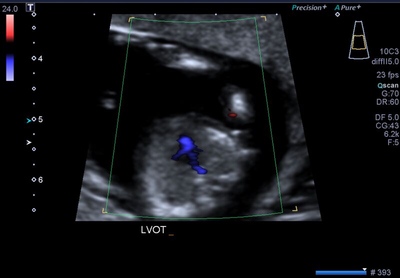 File:1st trimester nuchal-morphology ultrasound (Radiopaedia 44706-48477 General anatomy and NT 22).jpg