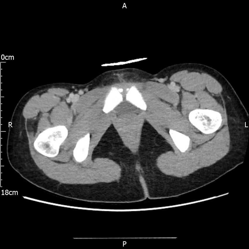 AAST grade IV kidney injury with CEUS follow-up (Radiopaedia 72353-82877 Axial C+ portal venous phase 81).jpg