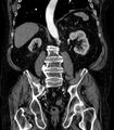 Abdominal aortic aneurysm (Radiopaedia 25855-26001 Coronal C+ arterial phase 48).jpg