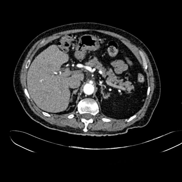 File:Abdominal aortic aneurysm (Radiopaedia 75131-86203 Axial C+ arterial phase 13).jpg