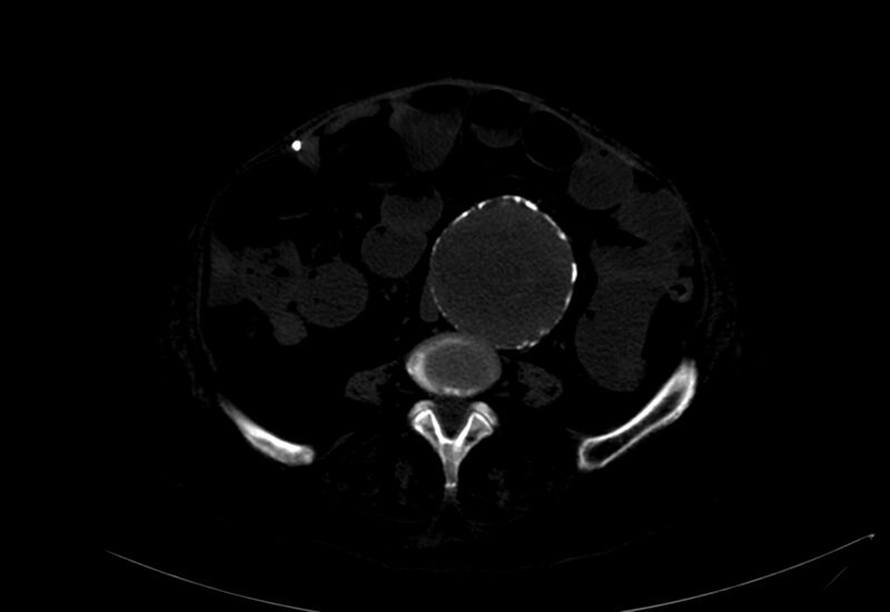 File:Abdominal aortic aneurysm - impending rupture (Radiopaedia 19233-19246 B 27).jpg