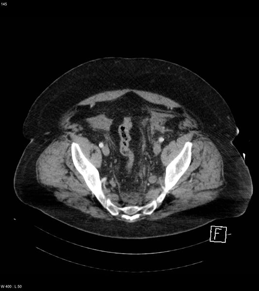 File:Abdominal aortic aneurysm with intramural hematoma then rupture (Radiopaedia 50278-55632 Axial C+ arterial phase 144).jpg