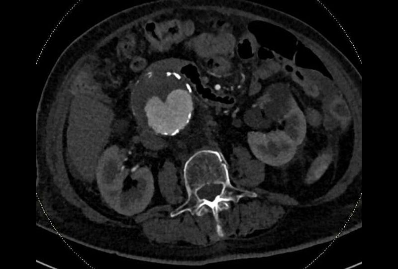File:Abdominal aortic aneurysm with thrombus fissuration (Radiopaedia 73192-83919 Axial C+ arterial phase 82).jpg