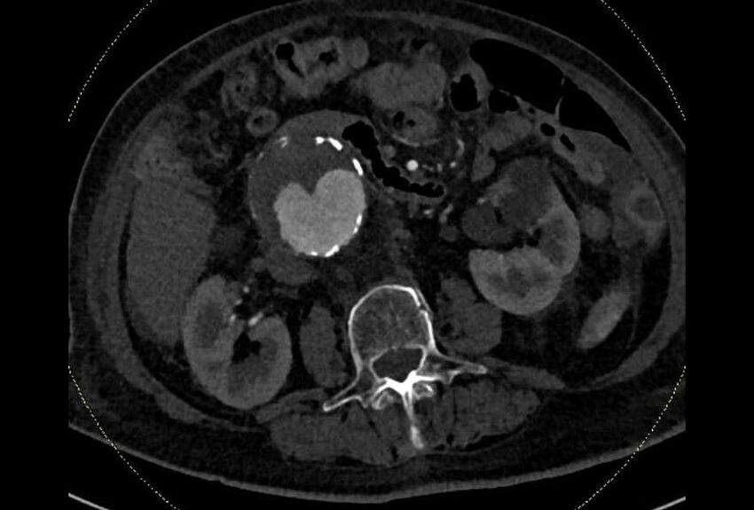 Abdominal aortic aneurysm with thrombus fissuration (Radiopaedia 73192-83919 Axial C+ arterial phase 82).jpg