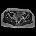 Abdominal wall endometriosis (Radiopaedia 83702-98847 Axial T2 8).jpg