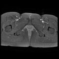 Abdominal wall endometriosis (Radiopaedia 83702-98847 H 19).jpg